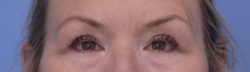 Blepharoplasty