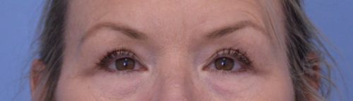 Blepharoplasty