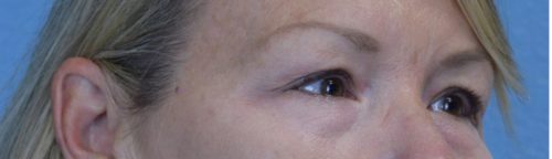 Blepharoplasty