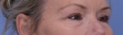 Blepharoplasty