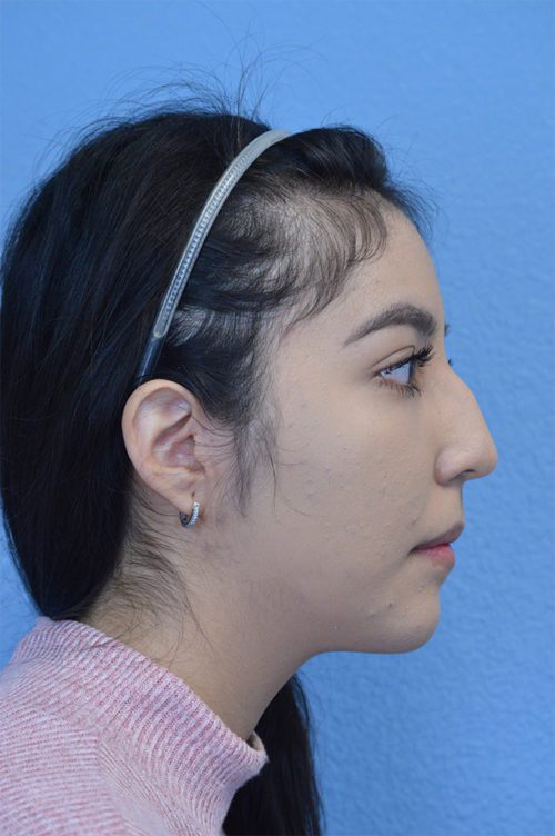 Rhinoplasty