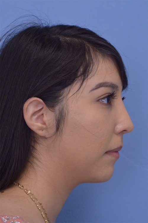 Rhinoplasty