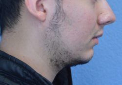 Chin Augmentation