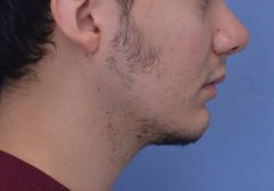 Chin Augmentation