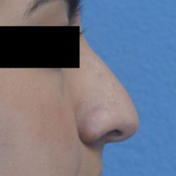 Rhinoplasty