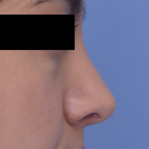 Rhinoplasty