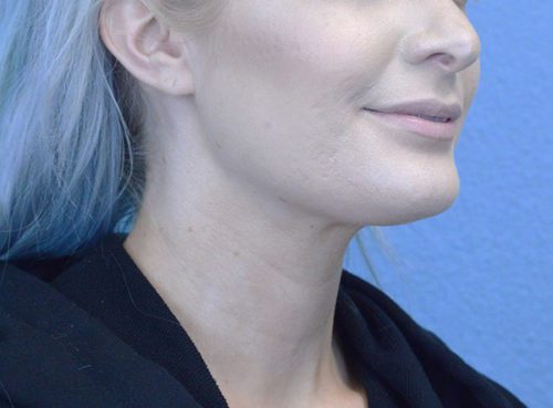 Chin Augmentation