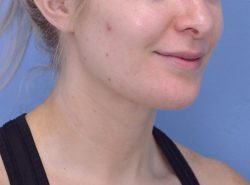 Chin Augmentation