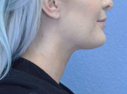 Chin Augmentation