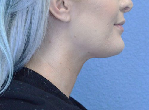 Chin Augmentation