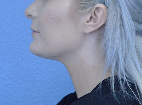 Chin Augmentation