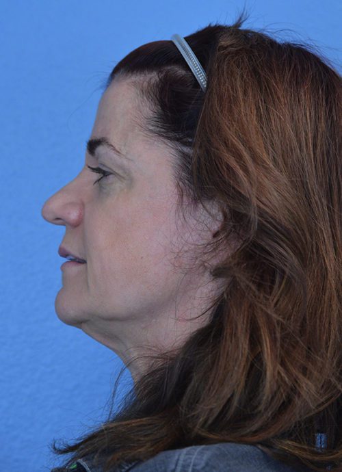 Face and Neck Lift