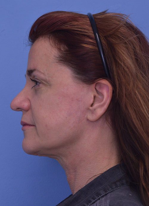 Face and Neck Lift