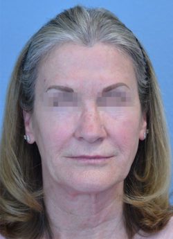 Face and Neck Lift