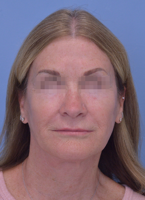 Face and Neck Lift