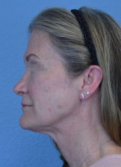 Face and Neck Lift