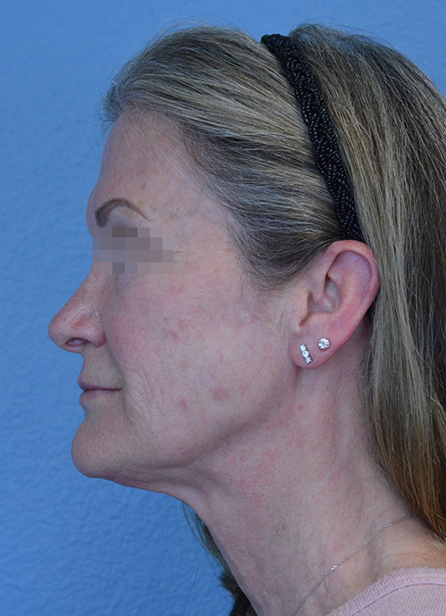 Face and Neck Lift