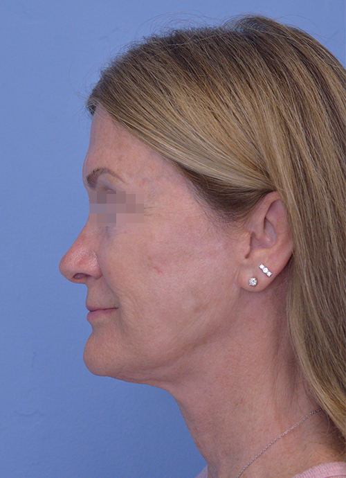 Face and Neck Lift