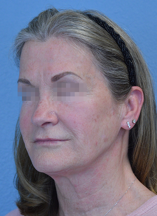 Face and Neck Lift