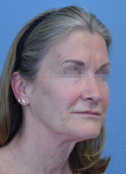 Face and Neck Lift