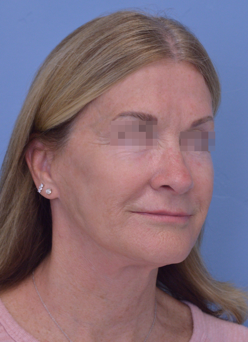 Face and Neck Lift