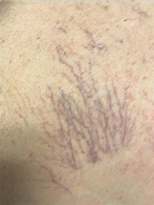 Laser Vein Removal Results Reno