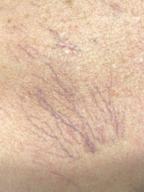 Laser Vein Removal Results Reno