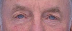 Blepharoplasty