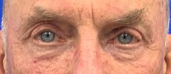 Blepharoplasty