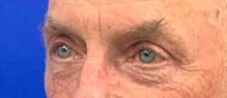 Blepharoplasty