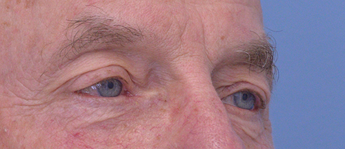 Blepharoplasty