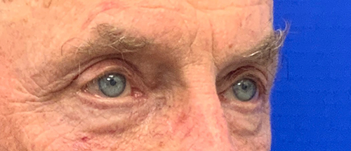 Blepharoplasty