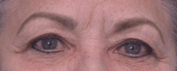 Blepharoplasty