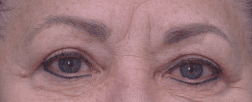 Blepharoplasty