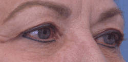 Blepharoplasty