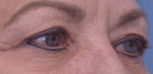 Blepharoplasty