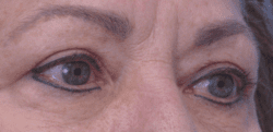 Blepharoplasty