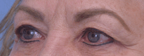 Blepharoplasty