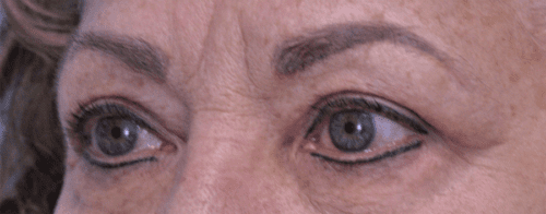 Blepharoplasty