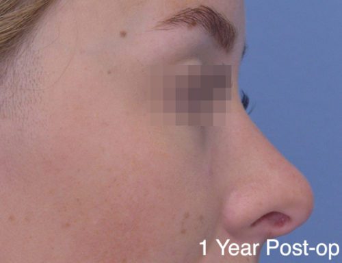 Rhinoplasty