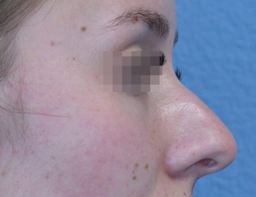 Rhinoplasty