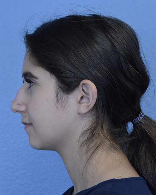 Rhinoplasty