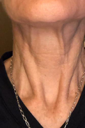 Anti Wrinkle Results Reno
