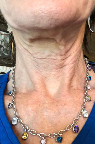 Anti Wrinkle Results Reno