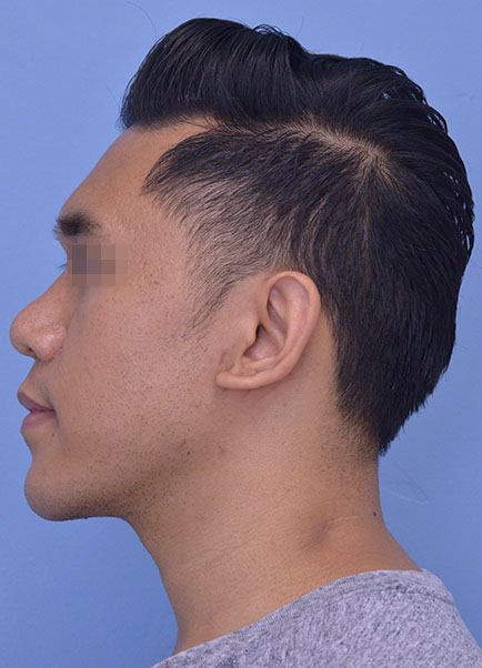 Rhinoplasty