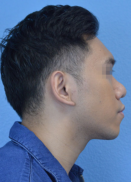 Rhinoplasty