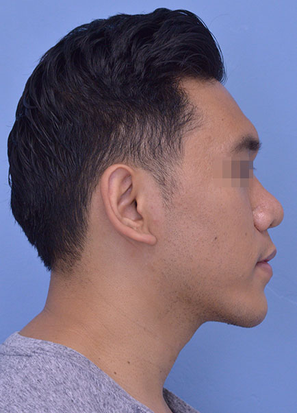 Rhinoplasty