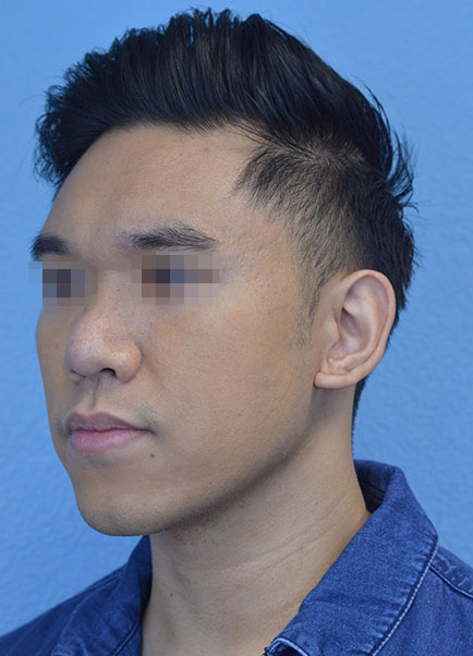 Rhinoplasty