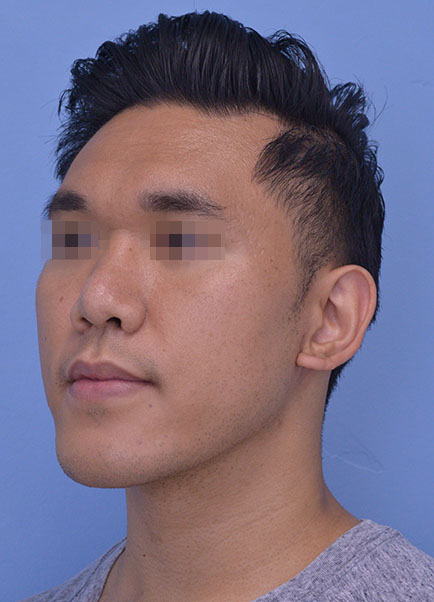 Rhinoplasty