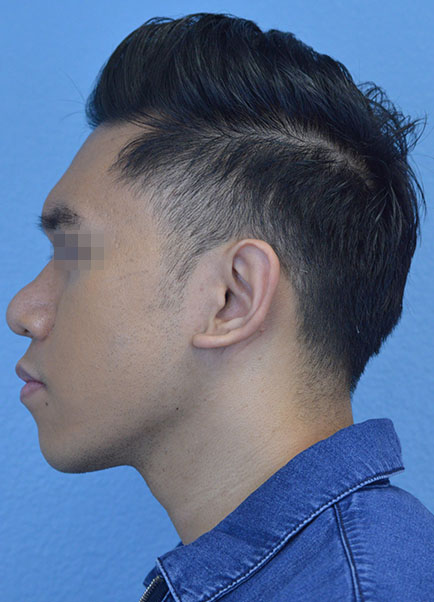 Rhinoplasty